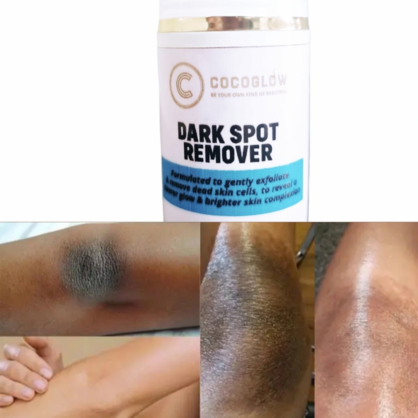 Dark spot remover cream