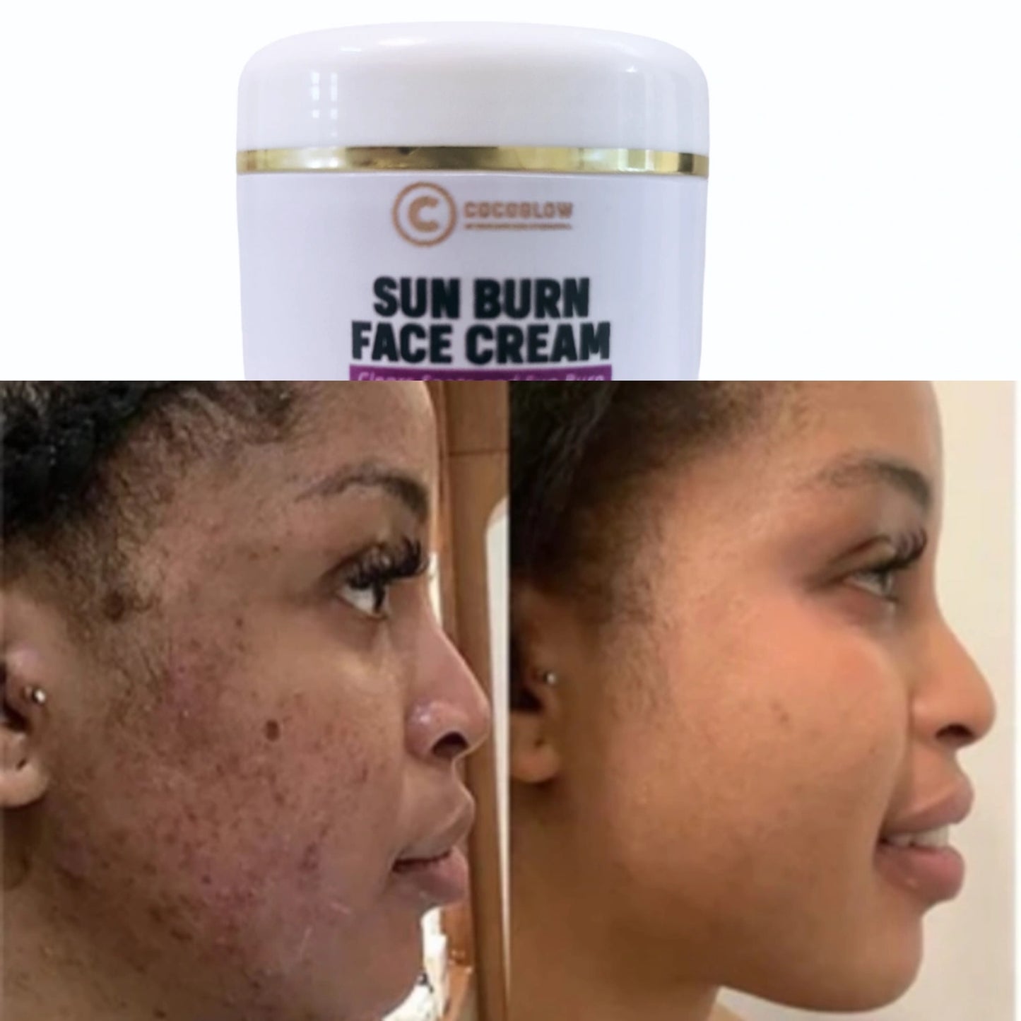 Sunburn face cream