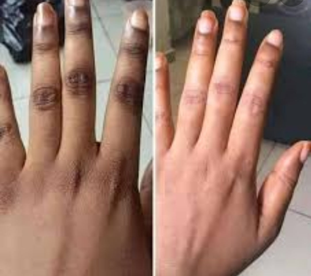 Dark spot remover cream