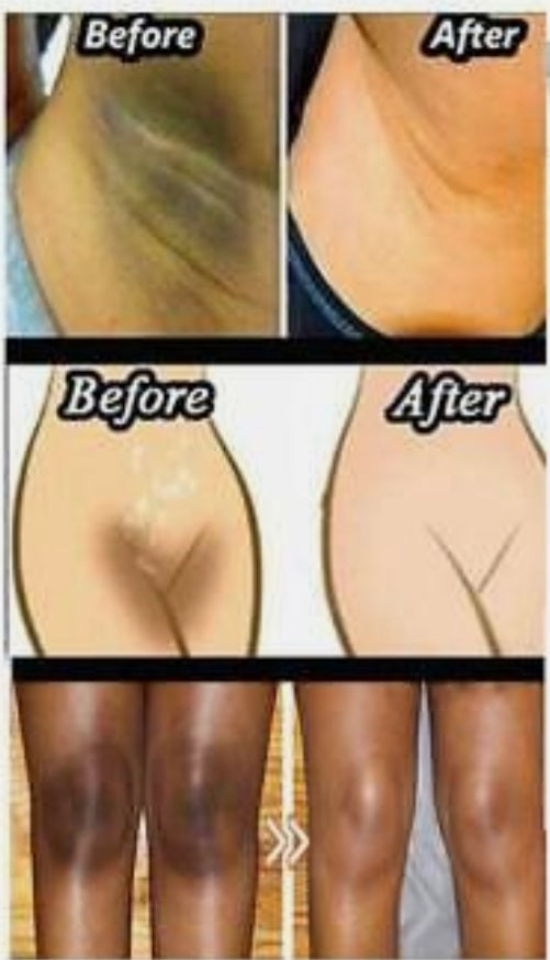 Dark spot remover cream